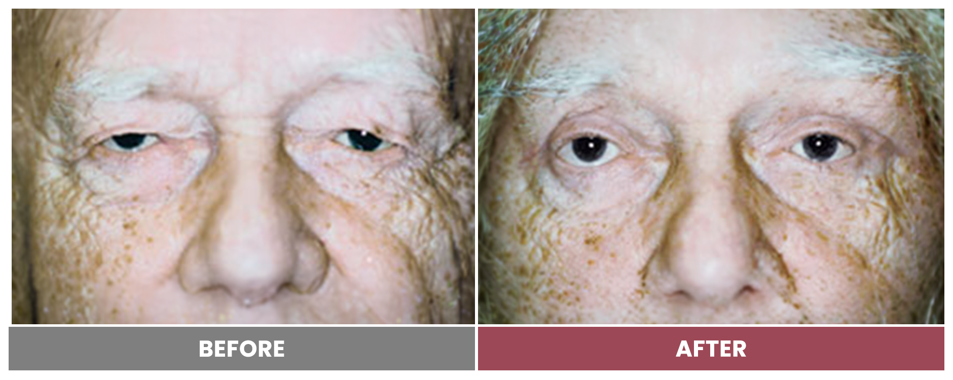 Upper Blepharoplasty - Case 86